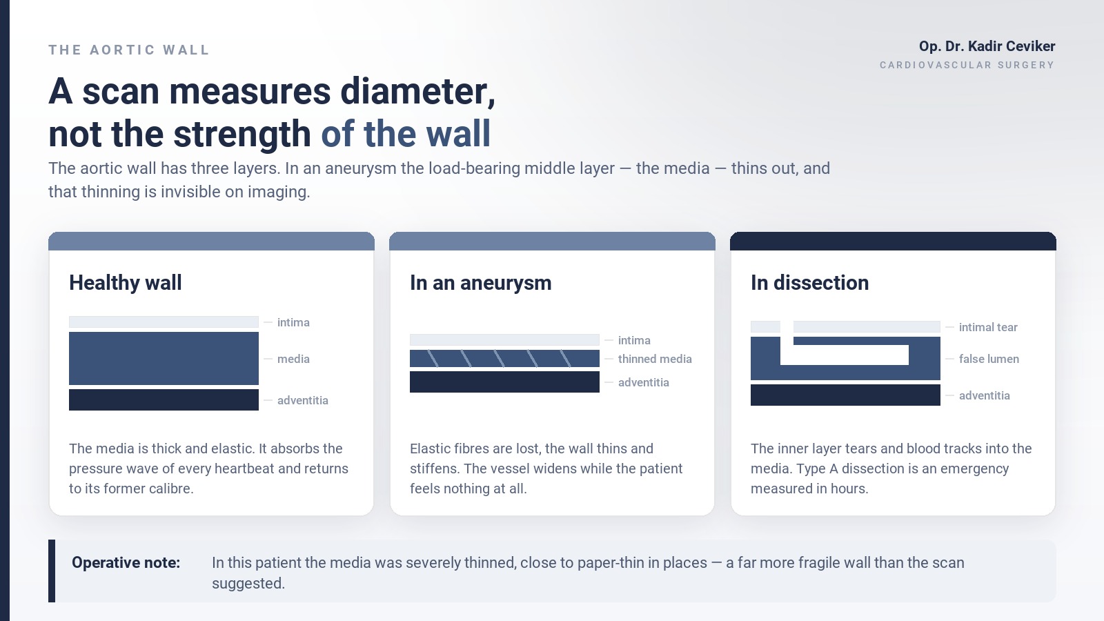Cross-section diagram of the aortic wall: healthy wall, thinned media in an aneurysm, and false lumen in dissection