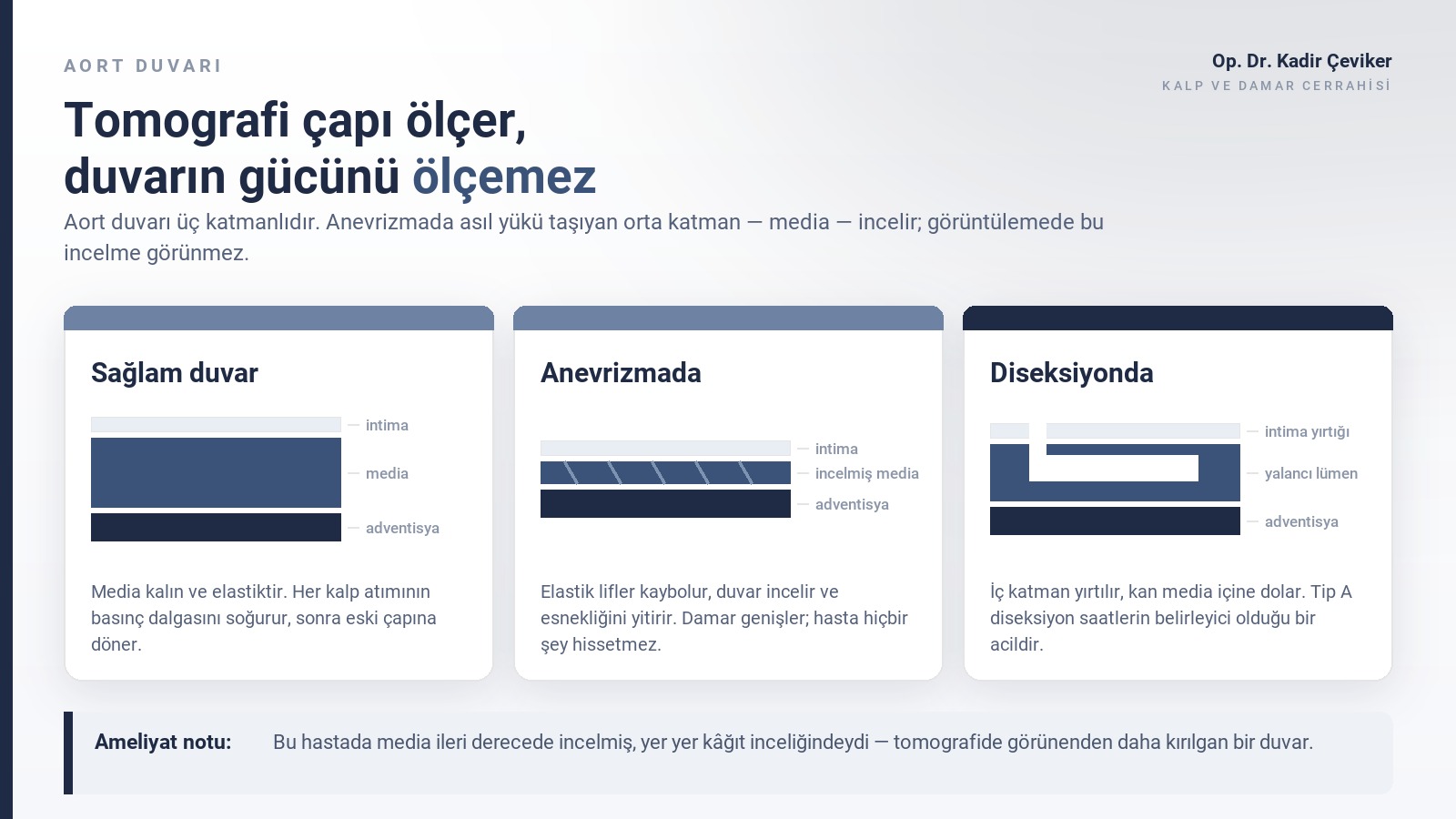 Aort duvarı kesiti şeması: sağlam duvar, anevrizmada incelmiş media ve diseksiyonda yalancı lümen
